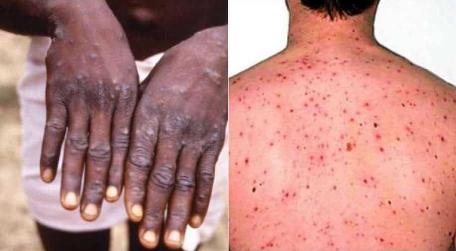 Apa itu Cacar Monyet atau Monkey Pox Virus ?